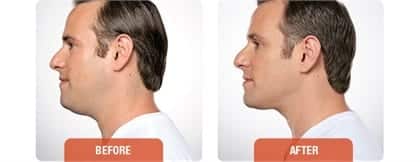 Male face, before and after Kybella treatment, patient 2
