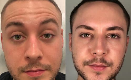 What to Expect from my BOTOX Appointment