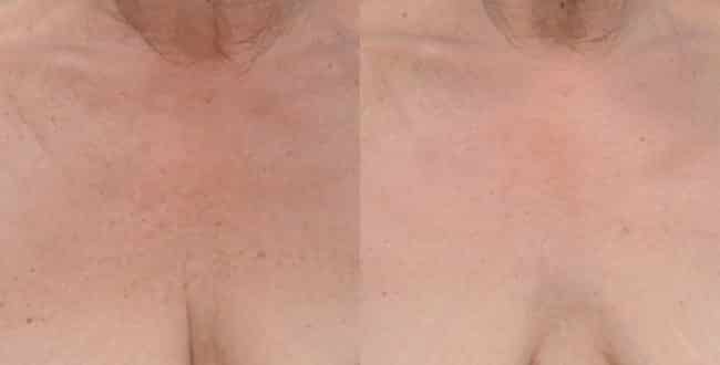 Woman's breast, before and after BroadBand Light treatments, patient 1