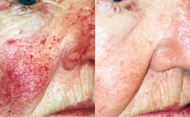 Woman's face, before and after VBeam pulsed dye laser treatments, patient 1