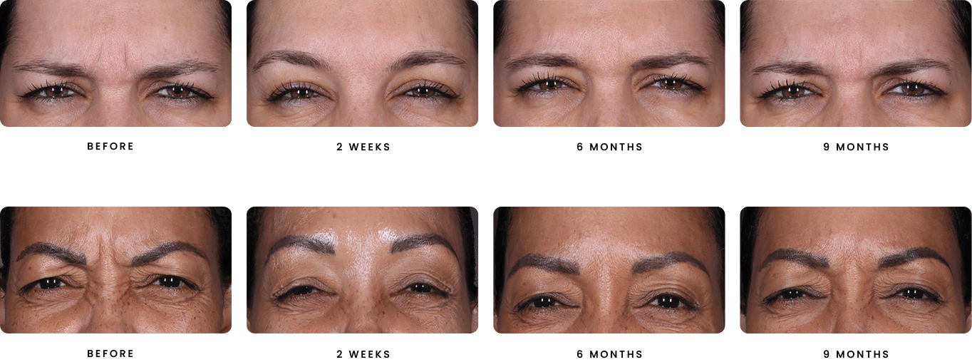 Females faces, before and after daxxify treatment (2 week/6 months/9 months)